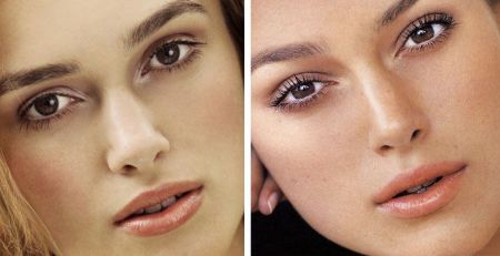 Keira before and after Nose Job (Rhinoplasty) and Lips Augmentation